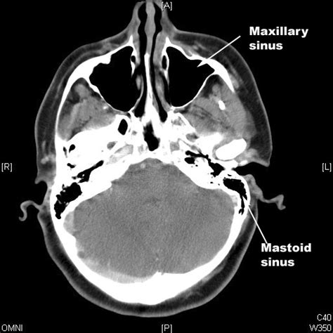Identify Maxuillary And Mastoid Sinus