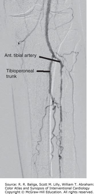 Infrapopliteal Disease Thoracic Key