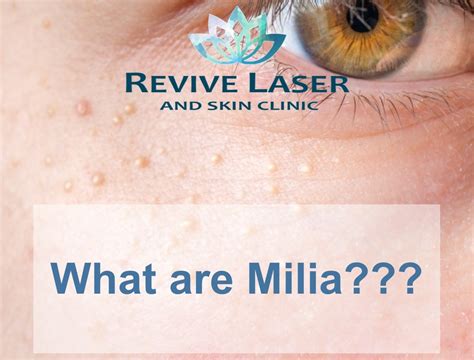 Revive Laser Blog What Are Milia