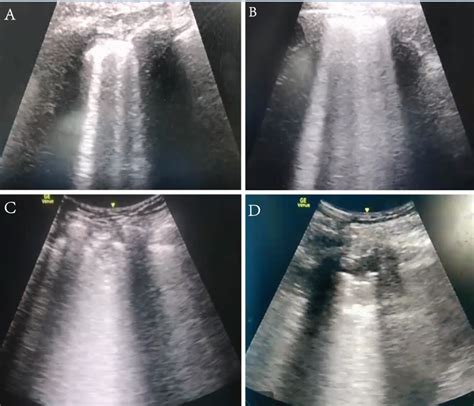 Features Of Lung Ultrasound In Covid 19 Infection Critical Care