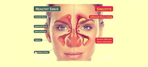 Recognizing Sinus Infection Symptoms And When To Seek Help