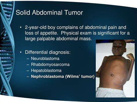 Ppt Pediatric Abdominal Tumors A Focus On Wilms Tumor