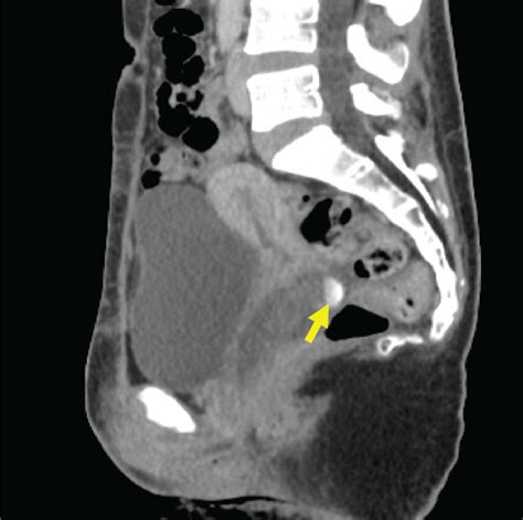 Pelvic Computed Tomography Scan Sagittal View Reveals A Large Mass