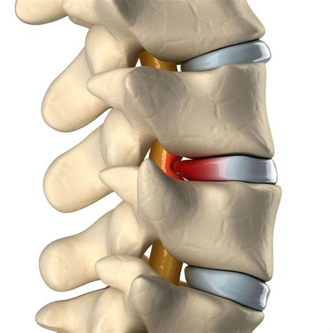 Pin On Pain Treatments Available From Novus Spine And Pain Center