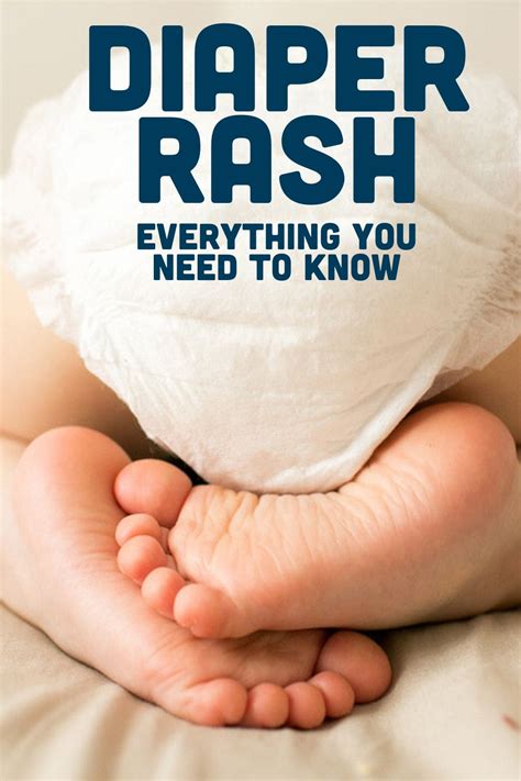 Should You Use Baby Wipes On Diaper Rash Ruling Weblogs Efecto