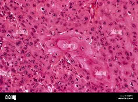 Carcinoma Epidermoide Fotografías E Imágenes De Alta Resolución Alamy