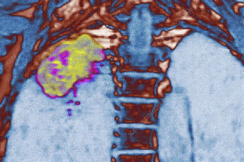 Lung Cancer X Ray Stock Image C0555014 Science Photo Library