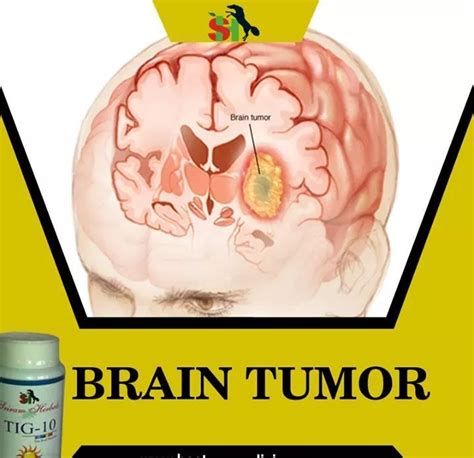 Brain Tumor Treatment At Best Price In Bengaluru