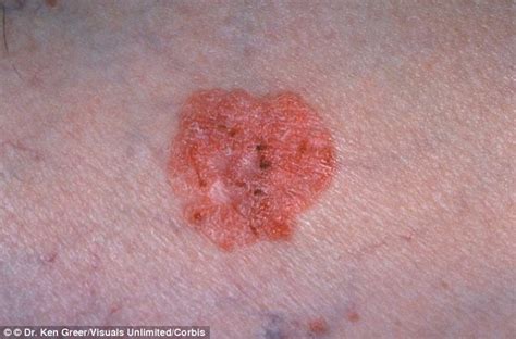 Revealed How To Tell If You Have Skin Cancer From Bleeding Itchy
