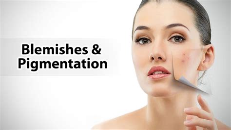 Blemishes And Pigmentation Youtube