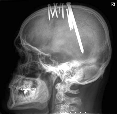 A Case Of Self Inflicted Craniocerebral Penetrating Injury James Et