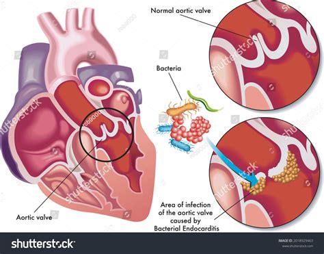 687 Endocarditis Stock Illustrations Images And Vectors Shutterstock