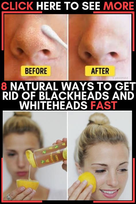 8 Natural Ways To Get Rid Of Blackheads And Whiteheads Fast Get Rid