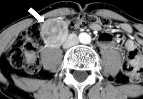 Gastrointestinal Stromal Tumors Of The Duodenum Ct And Barium Study