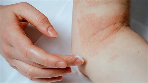 Eczema Causes Symptoms And Treatment Options Thepurepulse