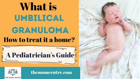 How To Treat Umbilical Granuloma At Home The Mom Centre