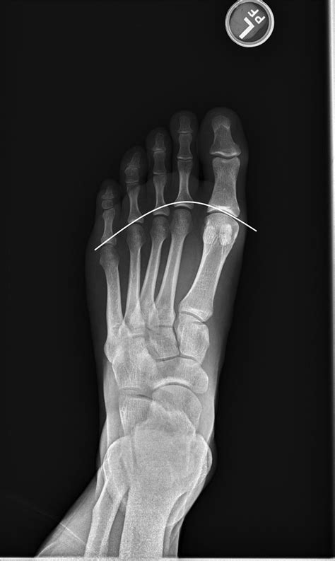 Metatarsal Osteotomies Foot And Ankle Clinics