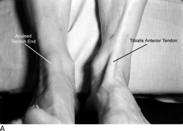 Injuries To The Tibialis Anterior Peroneal Tendons And Long Flexors