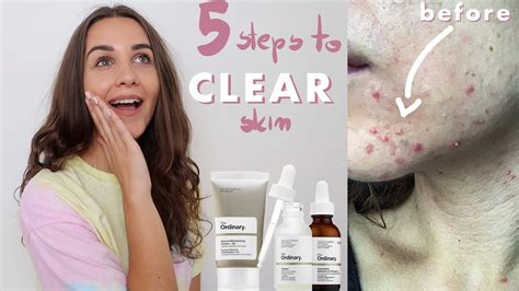 5 Acne Out Products That Cleared My Skin The Ordinary Skincare Youtube