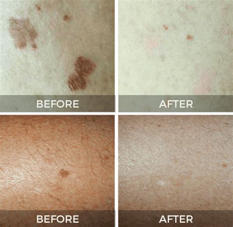 Cryoclear Cryotherapy For Skin Tags And Age Spots Cryoconcepts