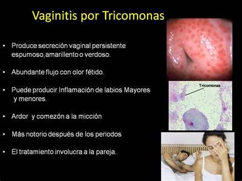 Salud Para La Mujer Y El Hombre Infecciones Vaginales Que Son Y Como Prevenirlos