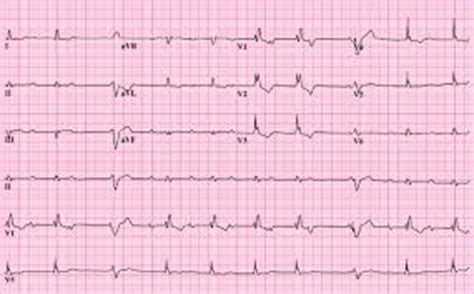 A position statement of the european society of cardiology working group on myocardial and pericardial diseases. Super veste! Brotac Medical Center are grijă de inima ta! Îți oferă gratuit electrocardiograma ...