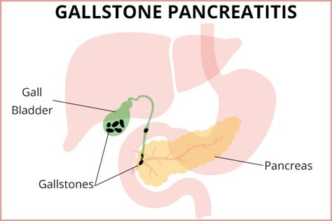 Gallstone Pancreatitis Causes Symptoms And Treatment
