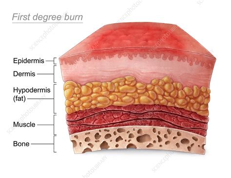 Select from premium first degree burn of the highest quality. First Degree Burn - Stock Image - C030/5962 - Science ...