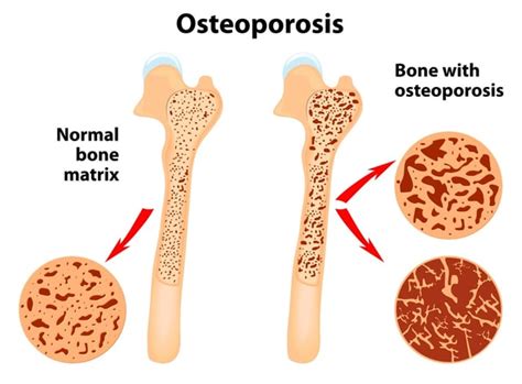 What Is Osteoporosis Signs Symptoms And Risks