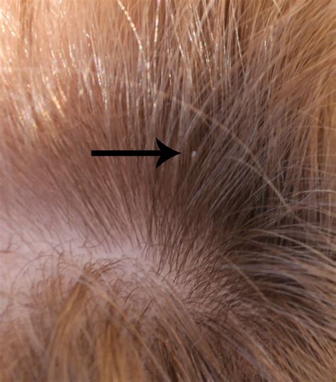 Head Lice Eggs On Blonde Hair The Image Kid Has It
