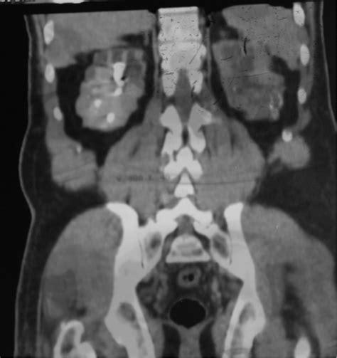 Axial Contrast Enhanced Ct Of The Abdomen A Showing A Staghorn
