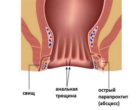Rectal Fistula Symptoms Treatment Diagnostics In Tashkent