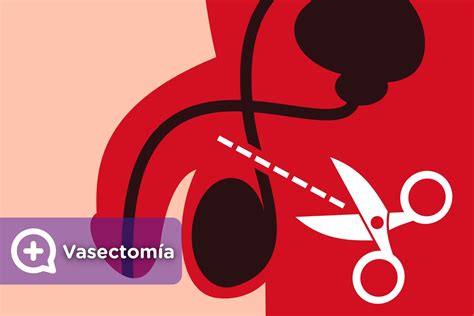 A vasectomia é um procedimento muito simples e eficaz. La vasectomía como método anticonceptivo seguro - mediQuo