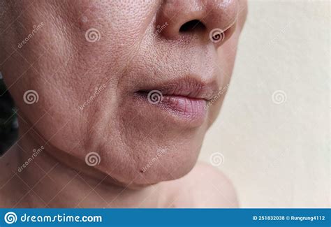 The Flabbiness Adipose Sagging Skin Beside The Mouth Wrinkles And