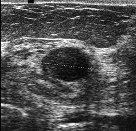 Cystic Breast Lesions Rinaldi 2010 Journal Of Ultrasound In