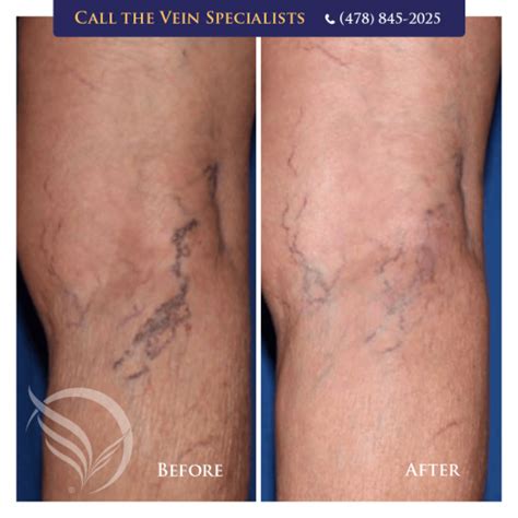 How To Get Rid Of Spider Veins Vein Specialists Of The South