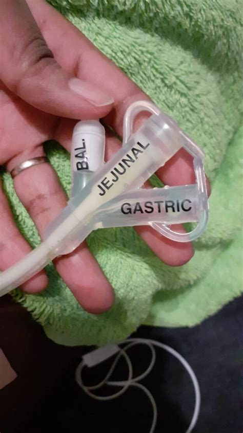 Peg Feeding Tube Tube Feeding Support Sa