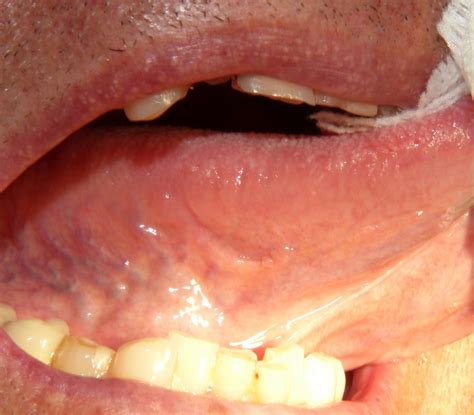 Papillary Lesion Under Tongue Squamous Papilloma In Tongue Squamous
