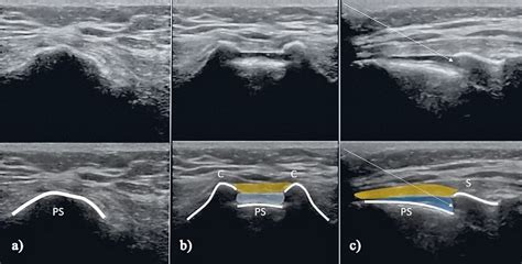 Ultrasound Guided Caudal Epidural Injection A Axial Image Showing The