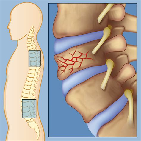 Spinal Fracture Causes Symptoms Treatments