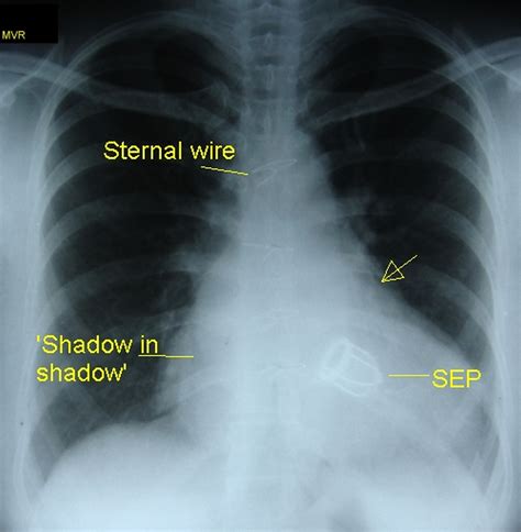 Prosthetic Mitral Valve Starr Edward Prosthesis On X Ray Chest