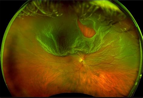 It consists of light sensitive cells that send signals to your brain and allow for you to see. Optos Giant Tear within Retinal Detachment - Retina Image Bank
