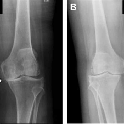Standard Weight Bearing Knee X Rays Of A 76 Year Old Female Before A