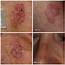 Premalignant Lesions  Skin Cancer 909