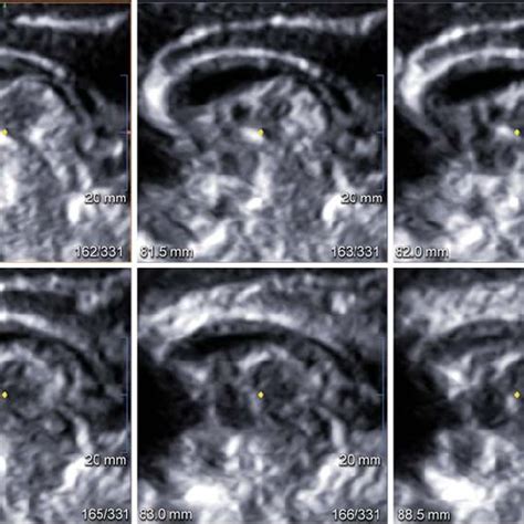Tomographic Ultrasound Imaging Of The Fetal Brain—corpus Callosum