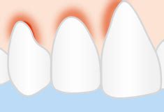 Geschwollenes Zahnfleisch Vorbeugung Ursachen
