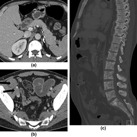 Imaging Of Rare Medullary Adrenal Tumours In Adults Clinical Radiology
