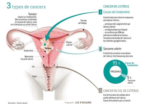Le rpccu vise à continuer de réduire les taux de mortalité et de morbidité du cancer du col de l'utérus et de ses précurseurs au pays grâce à la mise en œuvre ou à l'amélioration. Le cancer de l'utérus ne doit pas être négligé
