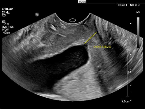 Ultrasound In Pregnancy Womens Ultrasound Melbourne