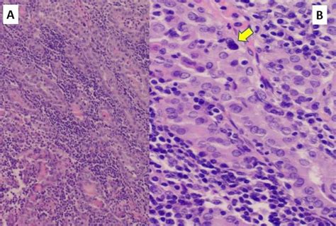 Histologic Sections Of Hashimotos Thyroiditis Showing Nuclear Atypia